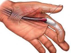 VIÊM GÂN GẤP NGÓN TAY ẢNH HƯỞNG NẶNG NỀ SỨC KHỎE!