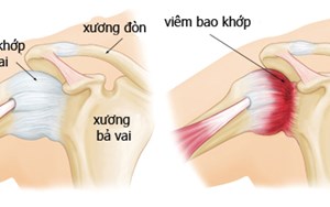 CHẨN ĐOÁN VÀ ĐIỀU TRỊ VIÊM QUANH KHỚP VAI ẢNH HƯỞNG ĐẾN SỨC KHỎE VÀ CUỘC SỐNG BỆNH NHÂN