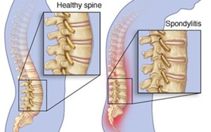 BỆNH VIÊM KHỚP THIẾU NIÊN TỰ PHÁT VIÊM CỘT SỐNG DÍNH KHỚP NGUY HIỂM NHƯ NÀO?