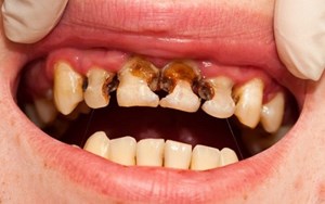 SÂU RĂNG SỮA LÀ GÌ VÀ BỆNH PHÁT TRIỂN NHƯ NÀO