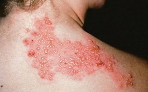 BỆNH ZONA PHÁT HIỆN VÀ ĐIỀU TRỊ ĐÚNG CÁCH