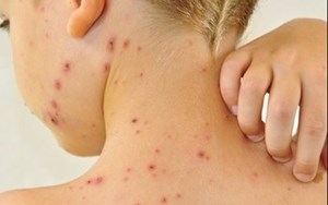 BỆNH GHẺ CÁCH PHÒNG TRỊ BỆNH GHẺ TRONG CỘNG ĐỒNG