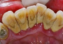 VIÊM QUANH RĂNG TIẾN TRIỂN CHẬM KHÓ NHẬN BIẾT SỚM