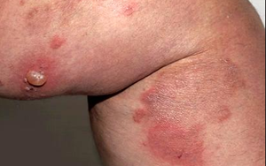 BỌNG NƯỚC DẠNG PEMPHIGUS PHÂN BIỆT VÀ PHÒNG TRỊ ĐÚNG CÁCH