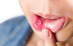 BỆNH APTHOSE DẤU HIỆU NHẬN BIẾT, TRIỆU CHỨNG VÀ ĐIỀU TRỊ