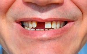 MẤT RĂNG TỪNG PHẦN MẤT THẨM MỸ
