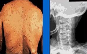 BỆNH U XƠ THẦN KINH PHÁC ĐỒ ĐIỀU TRỊ U XƠ THẦN KINH