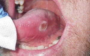 UNG THƯ LƯỠI HẬU QUẢ NGHIÊM TRỌNG ẢNH HƯỞNG SỨC KHỎE