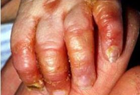 VIÊM DA ĐẦU CHI RUỘT CĂN BỆNH HIẾM GẶP DO THIẾU KẼM