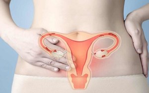 LẠC NỘI MẠC TỬ CUNG BIẾN CHỨNG GÂY VÔ SINH RẤT NGUY HIỂM!