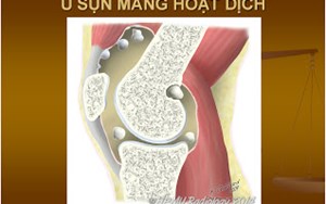 CHẨN ĐOÁN VÀ ĐIỀU TRỊ U SỤN MÀN HOẠT DỊCH CĂN BỆNH GÂY ẢNH HƯỞNG NẶNG NỀ CHO CUỘC SỐNG