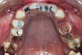 BỆNH SÂU RĂNG GÂY ẢNH HƯỞNG ĐẾN ĂN UỐNG NHƯ NÀO