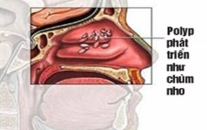 BỆNH POLYP MŨI ĐỪNG XEM THƯỜNG