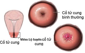 TỔN THƯƠNG LÀNH TÍNH CỔ TỬ CUNG NÊN CHỮA TRỊ CÀNG SỚM CÀNG TỐT KẺO HỐI HẬN