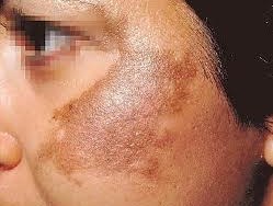 RÁM MÁ TRIỆU CHỨNG, NGUYÊN NHÂN VÀ CÁCH ĐIỀU TRỊ