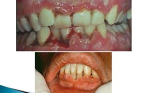 VIÊM LỢI LOÉT HOẠI TỬ CẤP TÍNH NGUYÊN NHÂN VÀ CÁCH CHỮA HIỆU QUẢ