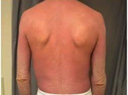 ĐỎ DA TOÀN THÂN  NHỮNG ĐIỀU CẦN BIẾT TRONG PHÒNG TRÁNH VÀ ĐIỀU TRỊ