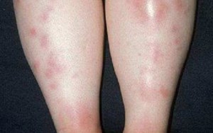 HỒNG BAN NÚT HÃY THẬN TRỌNG ĐỐI VỚI SỨC KHỎE CHÍNH MÌNH!