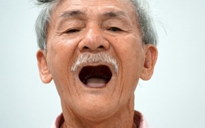 MẤT RĂNG TOÀN BỘ GÂY ẢNH HƯỞNG ĐẾN THẨM MỸ VÀ SINH HOẠT HẰNG NGÀY
