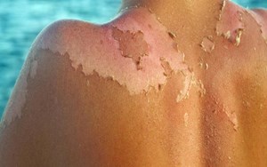 BỆNH DA DO ÁNH SÁNG BIỂU HIỆN, NGUYÊN NHÂN , CHẨN ĐOÁN VÀ ĐIỀU TRỊ