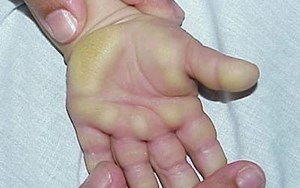 DÀY SỪNG LÒNG BÀN TAY, BÀN CHÂN DI TRUYỀN VÀ CÁCH ĐIỀU TRỊ