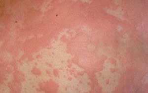 DỊ ỨNG DO CÔN TRÙNG ĐỐT