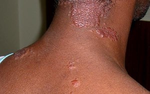 SARCOIDOSIS TRIỆU CHỨNG, CHẨN ĐOÁN VÀ ĐIỀU TRỊ