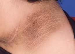 BỆNH GAI ĐEN TRIỆU CHỨNG VÀ ĐIỀU TRỊ