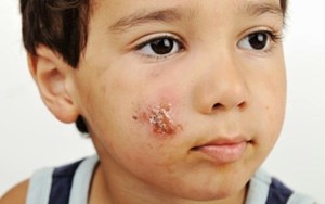 CHẨN ĐOÁN VÀ ĐIỀU TRỊ NHIỄM KHUẨN DA MÔ MỀM PHÁT HIỆN VÀ ĐIỀU TRỊ KỊP THỜI