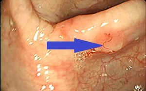 BỆNH NHIỄM GIUN TÓC DẤU HIỆU, TRIỆU CHỨNG, CHẨN ĐOÁN VÀ ĐIỀU TRỊ
