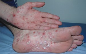 BỆNH GIANG MAI LÀ GÌ? TRIỆU CHỨNG VÀ ĐIỀU TRỊ