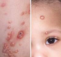 U MỀM LÂY NHẬN BIẾT VÀ CÁCH ĐIỀU TRỊ