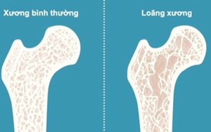 BỆNH LOÃNG XƯƠNG SỨC ẢNH HƯỞNG LỚN ĐẾN SỨC KHỎE!
