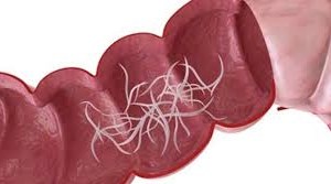BỆNH GIUN KIM NHẬN BIẾT, ĐIỀU TRỊ VÀ CHĂM SÓC