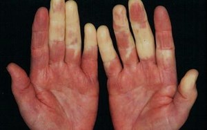 HỘI CHỨNG RAYNAUD DẤU HIỆU TRIỆU CHỨNG, NGUYÊN NHÂN VÀ PHƯƠNG PHÁP ĐIỀU TRỊ