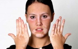 BỆNH BẠCH BIẾN VÀ GIẢI PHÁP ĐIỀU TRỊ