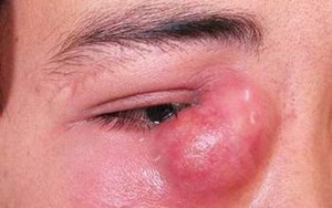 Bệnh viêm túi lệ Chậm điều trị, khóc cả đời