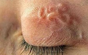 BỆNH KÝ SINH TRÙNG SÁN NHÁI CÓ THỂ GÂY XUẤT HUYẾT NÃO!