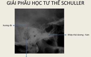 CHỤP X QUANG TƯ THẾ SCHULLER QUAN TRỌNG NHƯ NÀO