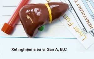 CK 001 Gói xét nghiệm siêu vi gan A, B, C