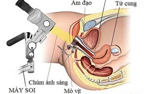 SOI CỔ TỬ CUNG