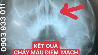 TRẺ EM - 2 THÁNG CHẢY MÁU MŨI HO KÉO DÀI NÊN MUA THUỐC UỐNG HAY ĐI KHÁM BS?