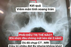 Nhức Đầu, Chóng Mặt Kéo Dài Dù Đã Chụp CT, MRI: Nguyên Nhân Có Thể Từ Viêm Xoang