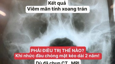 Nhức Đầu, Chóng Mặt Kéo Dài Dù Đã Chụp CT, MRI: Nguyên Nhân Có Thể Từ Viêm Xoang