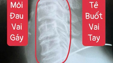 Dấu Hiệu Thoái Hóa Cột Sống Cổ Nặng: Nhận Biết Sớm Để Tránh Biến Chứng