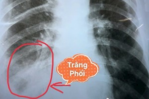 Sụt 5kg, Ho Sốt Kéo Dài 3 Tháng: Cảnh Báo Viêm Phổi Nặng Không Nên Chủ Quan