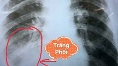 Sụt 5kg, Ho Sốt Kéo Dài 3 Tháng: Cảnh Báo Viêm Phổi Nặng Không Nên Chủ Quan