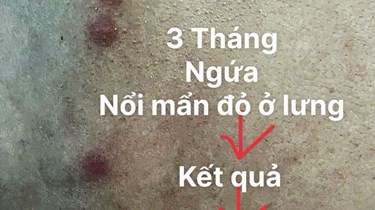 Ngứa Kéo Dài 3 Tháng, Phát Hiện Nhiễm Đồng Thời 2 Loại Ký Sinh Trùng