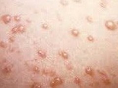 Những dấu hiệu mắc bệnh lây qua đường tình dục dễ bị bỏ qua