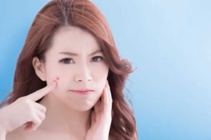 Bí kíp đánh bay sẹo mụn không phải ai cũng biết